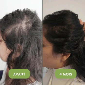 HairBoost : Solution Naturelle contre la Chute des Cheveux